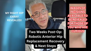 Two Weeks Post-Op Robotic Anterior Hip Replacement Recovery & Next Steps