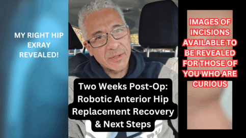 Two Weeks Post-Op Robotic Anterior Hip Replacement Recovery & Next Steps
